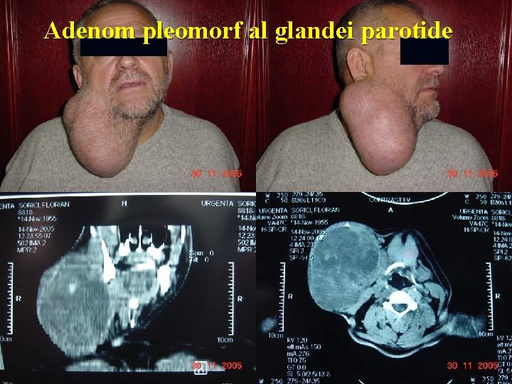 Adenom pleomorf al glandei parotide 