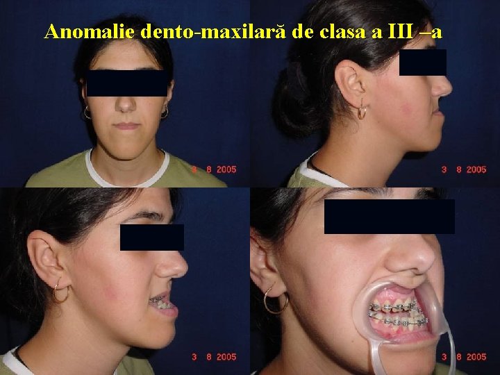 Anomalie dento-maxilară de clasa a III –a 