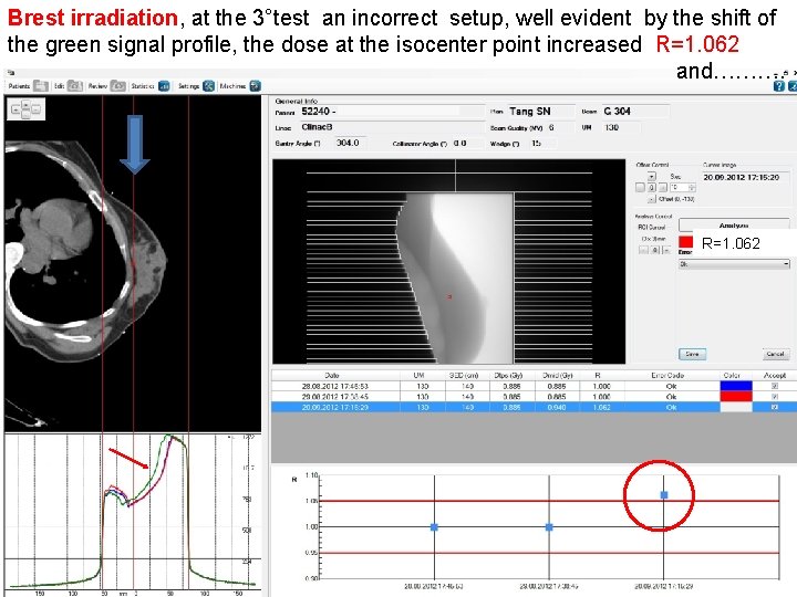 Brest irradiation, at the 3°test an incorrect setup, well evident by the shift of