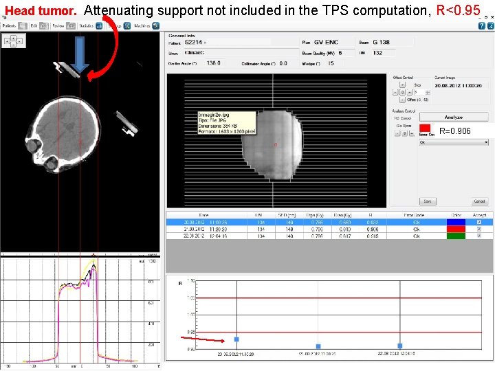 Head tumor. Attenuating support not included in the TPS computation, R<0. 95 R=0. 906