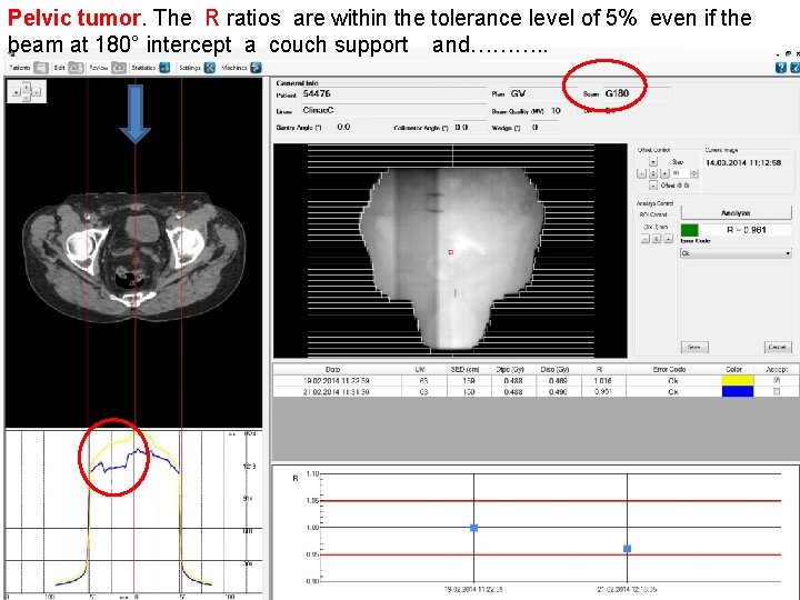 Pelvic tumor. The R ratios are within the tolerance level of 5% even if