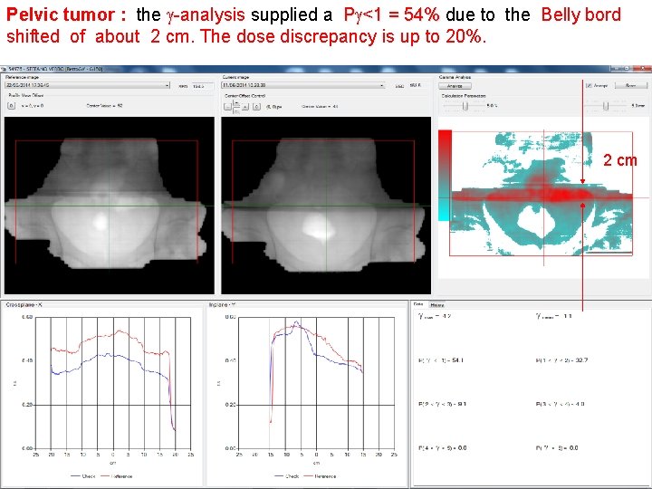 Pelvic tumor : the g-analysis supplied a Pg<1 = 54% due to the Belly