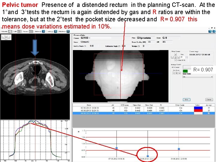 Pelvic tumor Presence of a distended rectum in the planning CT-scan. At the 1°and