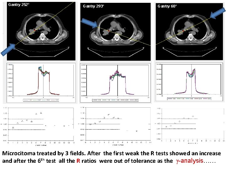 Gantry 252° Gantry 293° Gantry 60° Microcitoma treated by 3 fields. After the first