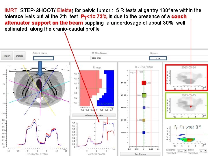 IMRT STEP-SHOOT( Elekta) for pelvic tumor : 5 R tests at gantry 180°are within