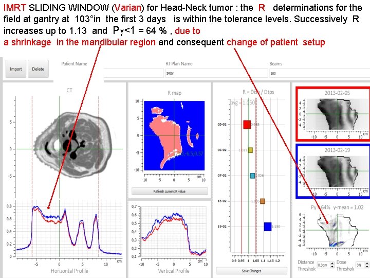 IMRT SLIDING WINDOW (Varian) for Head-Neck tumor : the R determinations for the field