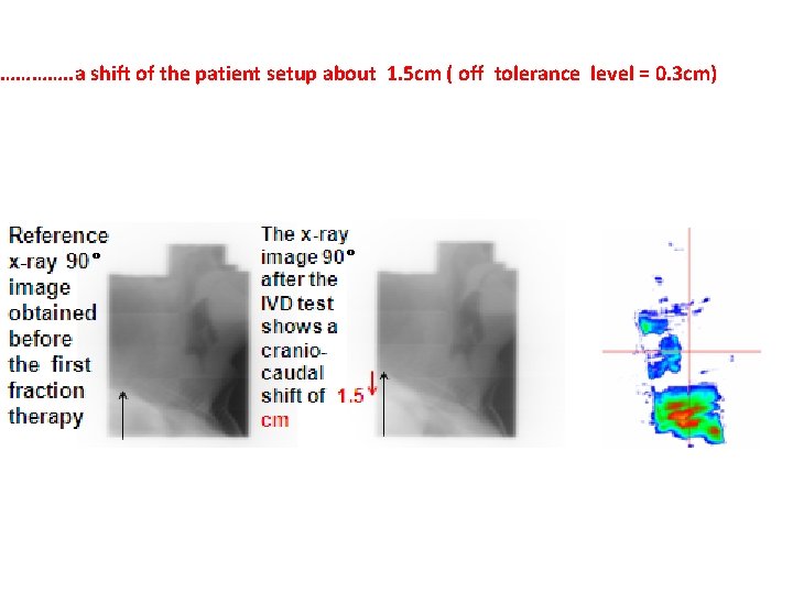 …………. . a shift of the patient setup about 1. 5 cm ( off