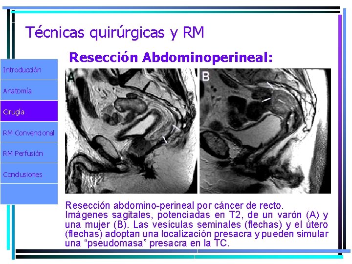 Técnicas quirúrgicas y RM Resección Abdominoperineal: Introducción Anatomía Cirugía RM Convencional RM Perfusión Conclusiones