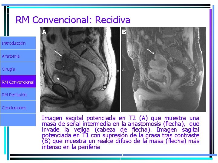 RM Convencional: Recidiva A B Introducción Anatomía Cirugía RM Convencional RM Perfusión Conclusiones Imagen