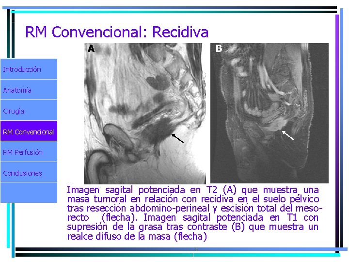 RM Convencional: Recidiva A B Introducción Anatomía Cirugía RM Convencional RM Perfusión Conclusiones Imagen