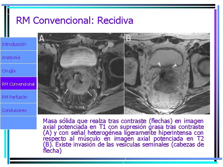 RM Convencional: Recidiva Introducción Anatomía Cirugía RM Convencional RM Perfusión Conclusiones Masa sólida que