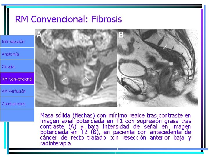 RM Convencional: Fibrosis Introducción Anatomía Cirugía RM Convencional RM Perfusión Conclusiones Masa sólida (flechas)