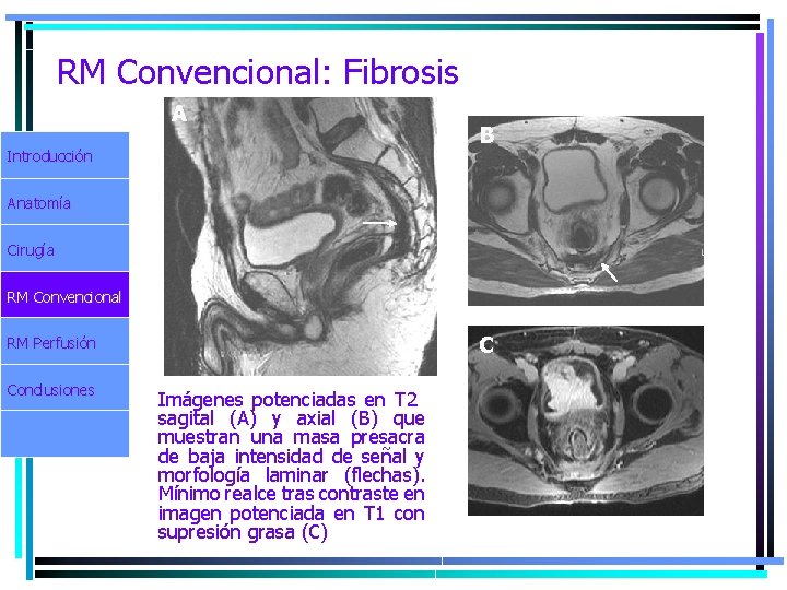 RM Convencional: Fibrosis A Introducción B Anatomía Cirugía RM Convencional C RM Perfusión Conclusiones