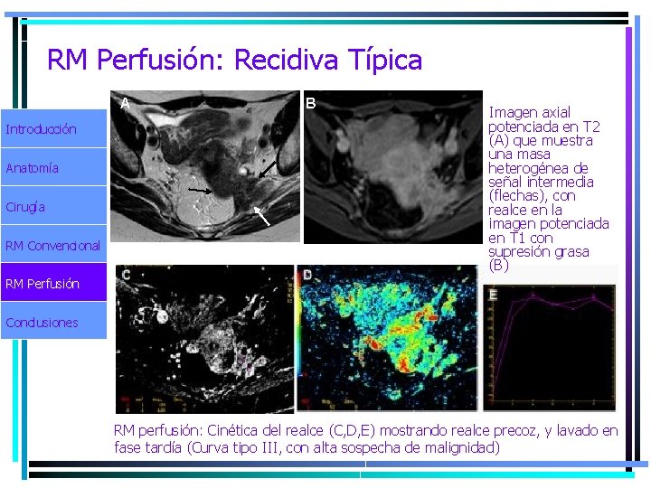 RM Perfusión: Recidiva Típica A Introducción Anatomía Cirugía RM Convencional B Imagen axial potenciada