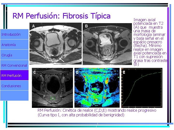 RM Perfusión: Fibrosis Típica A Introducción Anatomía Cirugía RM Convencional B Imagen axial potenciada