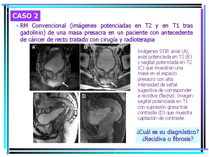 CASO 2 • RM Convencional (imágenes potenciadas en T 2 y en T 1