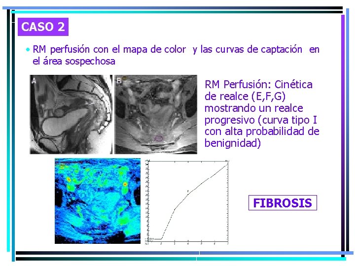 CASO 2 • RM perfusión con el mapa de color y las curvas de