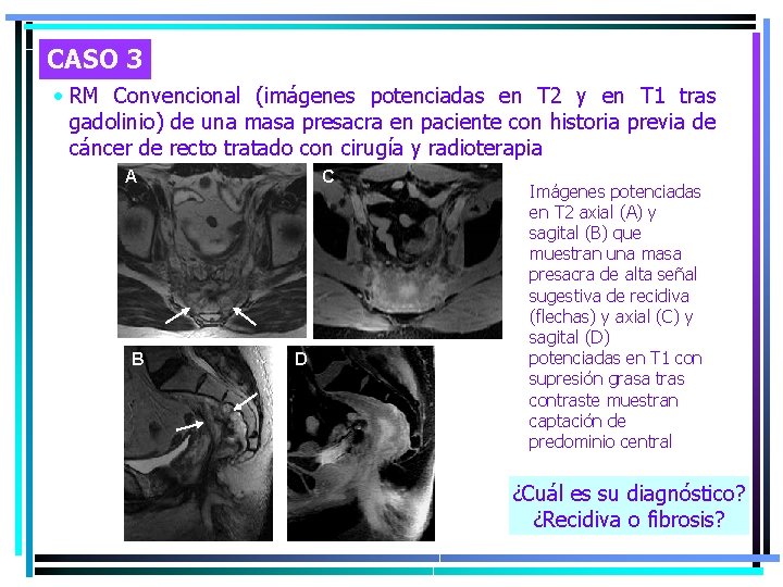 CASO 3 • RM Convencional (imágenes potenciadas en T 2 y en T 1