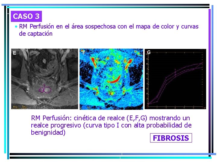 CASO 3 • RM Perfusión en el área sospechosa con el mapa de color