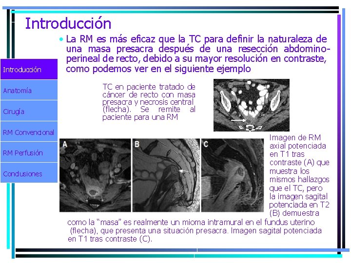 Introducción Anatomía Cirugía RM Convencional RM Perfusión Conclusiones • La RM es más eficaz