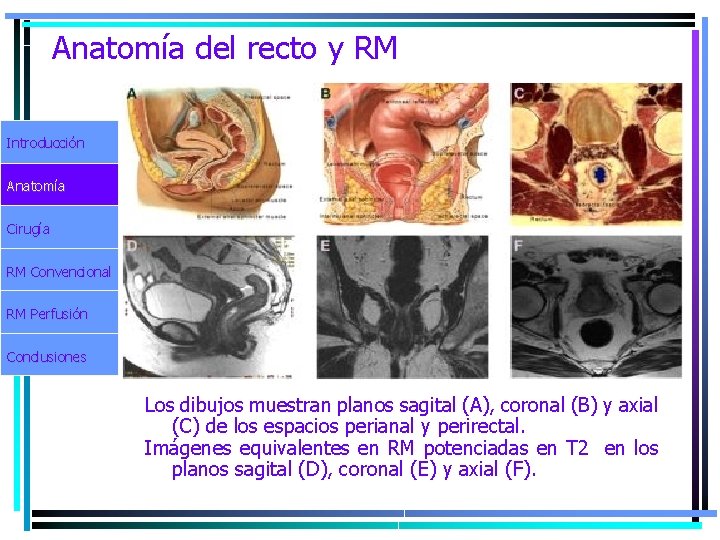 Anatomía del recto y RM Introducción Anatomía Cirugía RM Convencional RM Perfusión Conclusiones Los