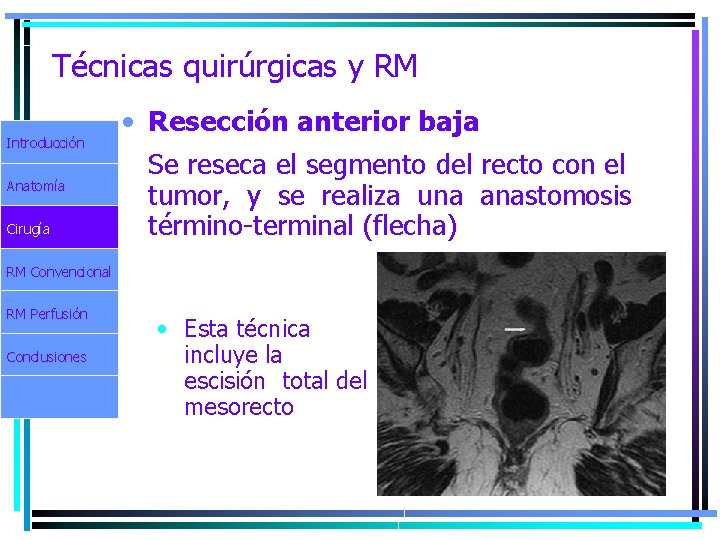 Técnicas quirúrgicas y RM Introducción Anatomía Cirugía • Resección anterior baja Se reseca el