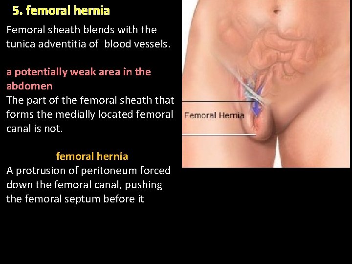 5. femoral hernia Femoral sheath blends with the tunica adventitia of blood vessels. a