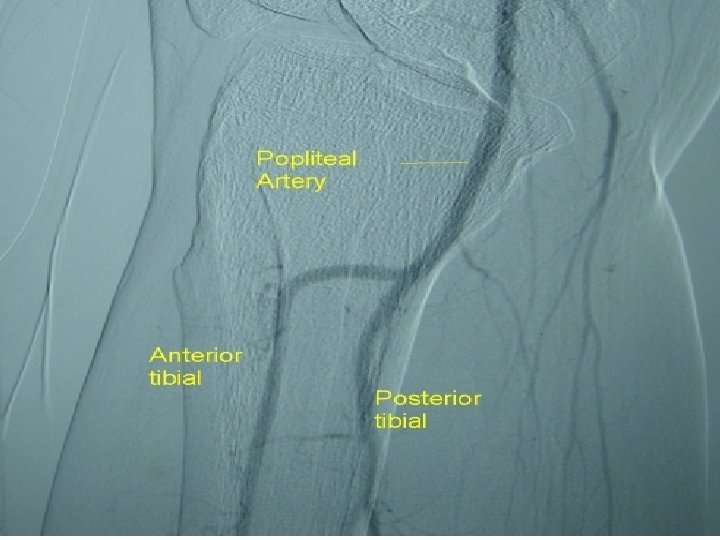 5. Popliteal artery/vein ØContinuation of the femoral artery ØBegins as the femoral artery passes