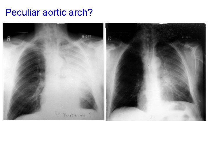 Peculiar aortic arch? arlllckkkh 