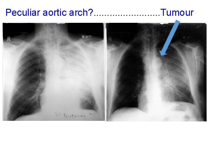 Peculiar aortic arch? . . . Tumour arlllckkkh 