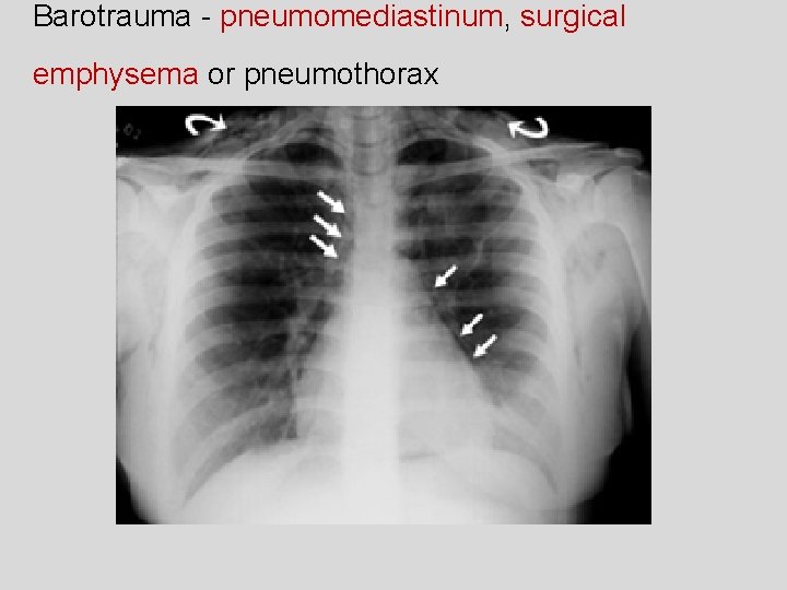 Barotrauma - pneumomediastinum, surgical emphysema or pneumothorax 