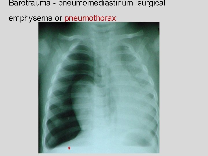 Barotrauma - pneumomediastinum, surgical emphysema or pneumothorax 