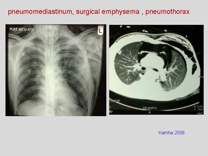 pneumomediastinum, surgical emphysema , pneumothorax Kamha 2008 