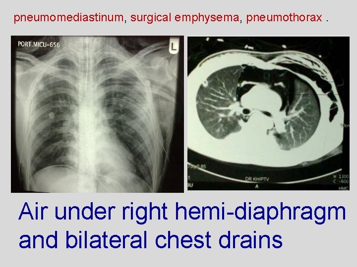 pneumomediastinum, surgical emphysema, pneumothorax. Air under right hemi-diaphragm and bilateral chest drains 