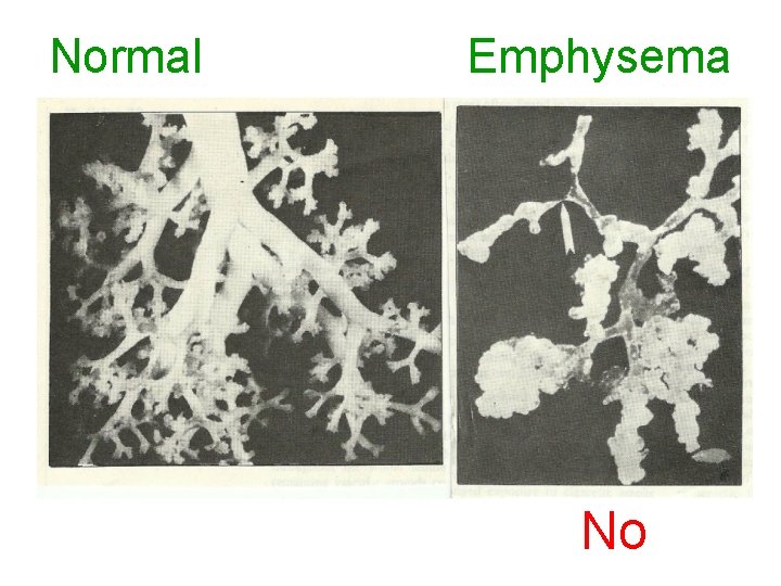 Normal Emphysema No 