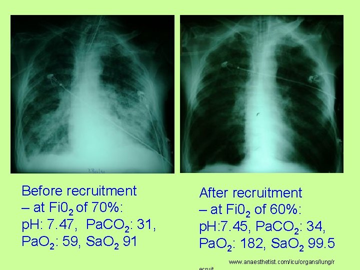 Before recruitment – at Fi 02 of 70%: p. H: 7. 47, Pa. CO