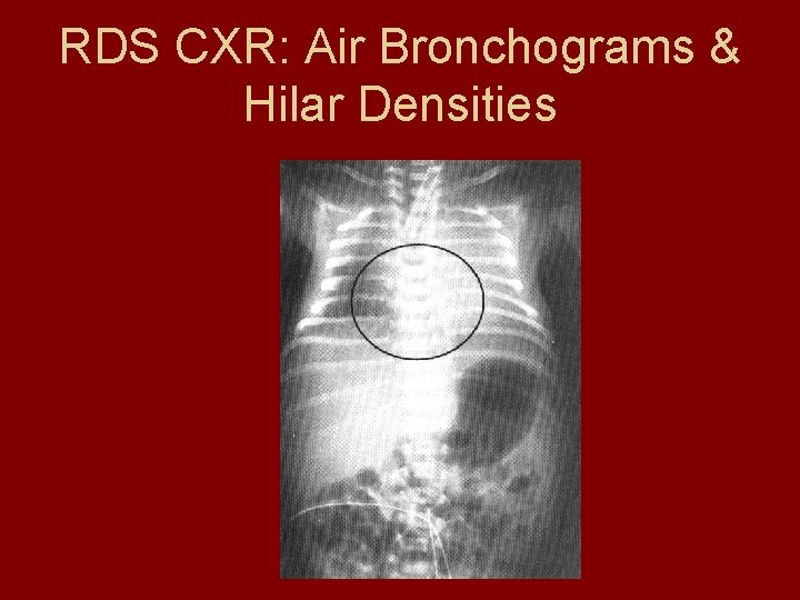 Cxr In Rds Neonatal Diseases common causes of respiratory distress in