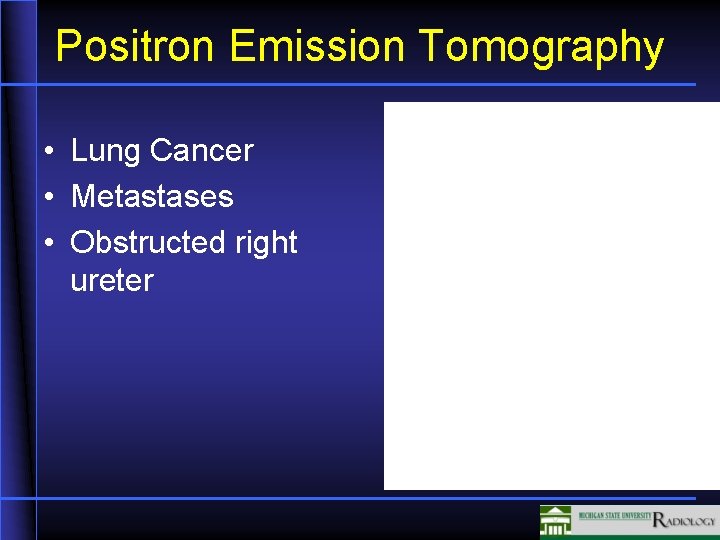 Positron Emission Tomography • Lung Cancer • Metastases • Obstructed right ureter 