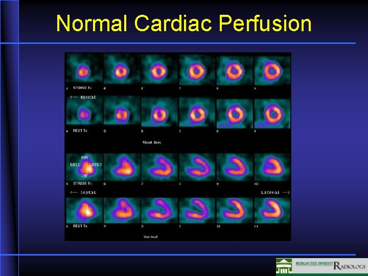 Normal Cardiac Perfusion 