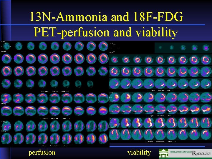 13 N-Ammonia and 18 F-FDG PET-perfusion and viability perfusion viability 