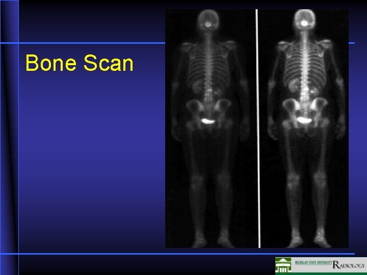 Bone Scan 