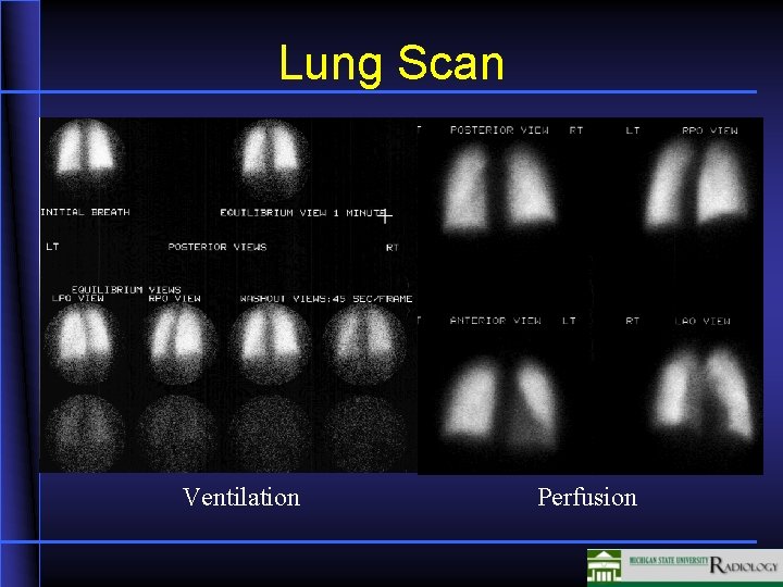 Lung Scan Ventilation Perfusion 