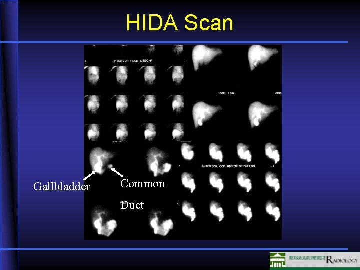 HIDA Scan Gallbladder Common Duct 