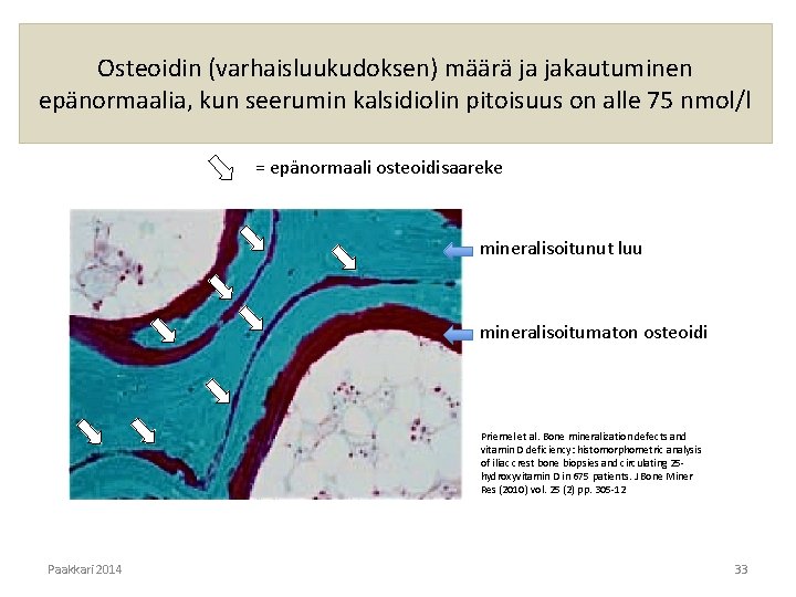 Osteoidin (varhaisluukudoksen) määrä ja jakautuminen epänormaalia, kun seerumin kalsidiolin pitoisuus on alle 75 nmol/l