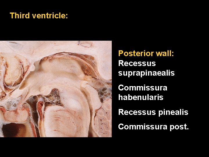 Third ventricle: Posterior wall: Recessus suprapinaealis Commissura habenularis Recessus pinealis Commissura post. 