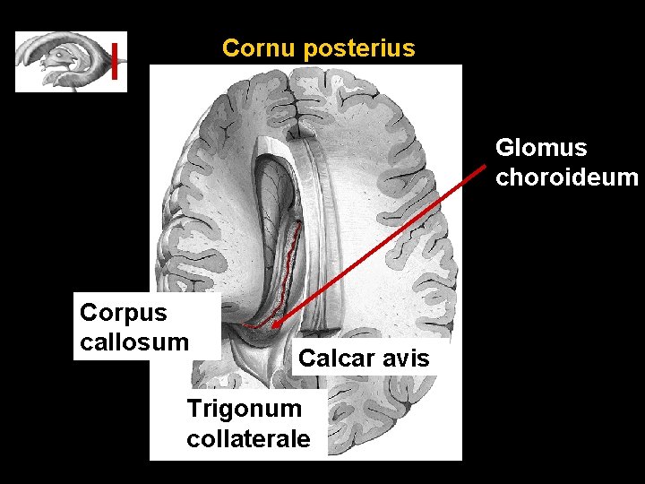 Cornu posterius Glomus choroideum Corpus callosum Calcar avis Trigonum collaterale 