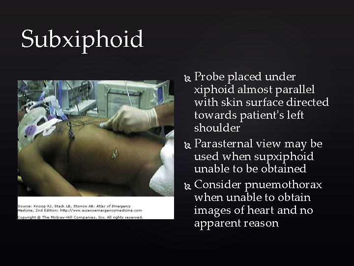 Subxiphoid Probe placed under xiphoid almost parallel with skin surface directed towards patient’s left