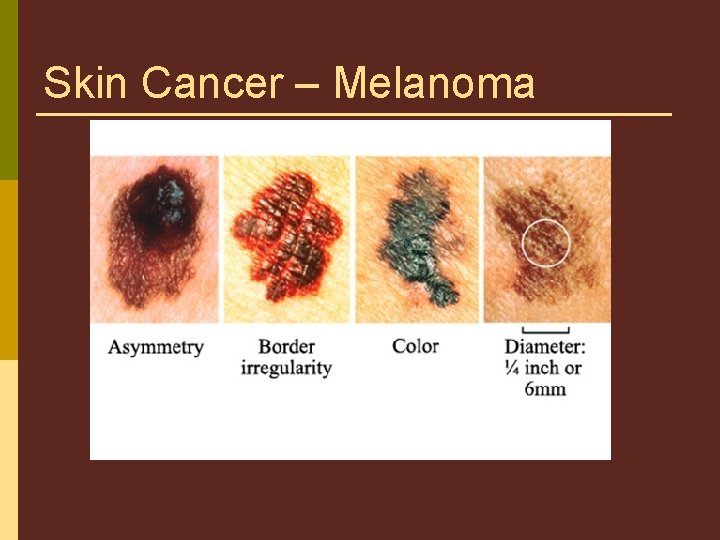 Skin Cancer – Melanoma 
