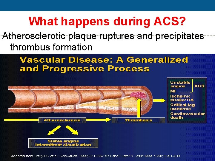 What happens during ACS? Atherosclerotic plaque ruptures and precipitates thrombus formation 