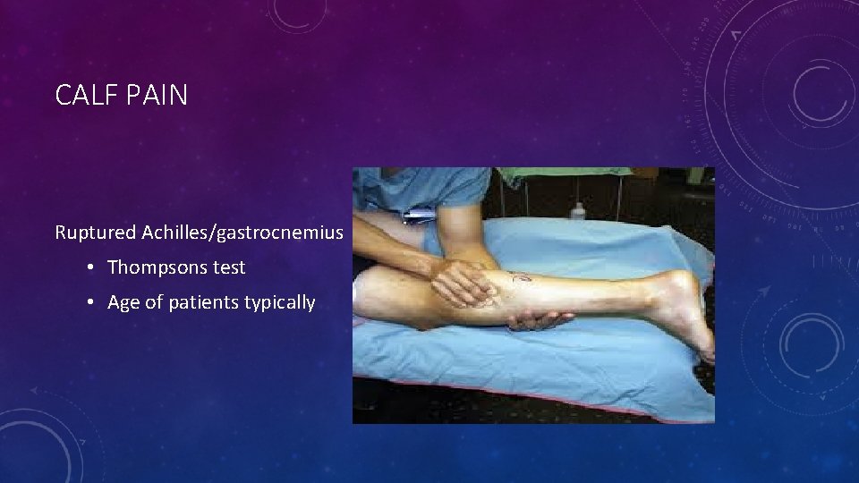 CALF PAIN Ruptured Achilles/gastrocnemius • Thompsons test • Age of patients typically 